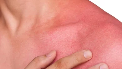 ۱۰ عامل که سبب قرمزی پوست می شود و راه های درمان آن ها