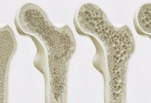 درمان پوکی استخوان + 7 روش طبیعی برای افزایش تراکم استخوان
