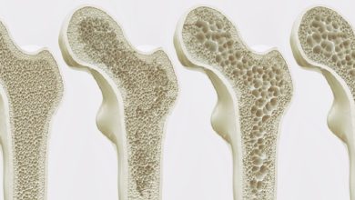 درمان پوکی استخوان + 7 روش طبیعی برای افزایش تراکم استخوان